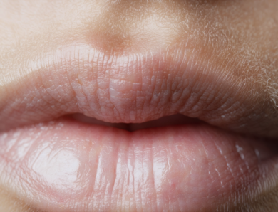 Mucocele de la lèvre : comprendre ses origines, reconnaître les signes et découvrir les solutions adaptées